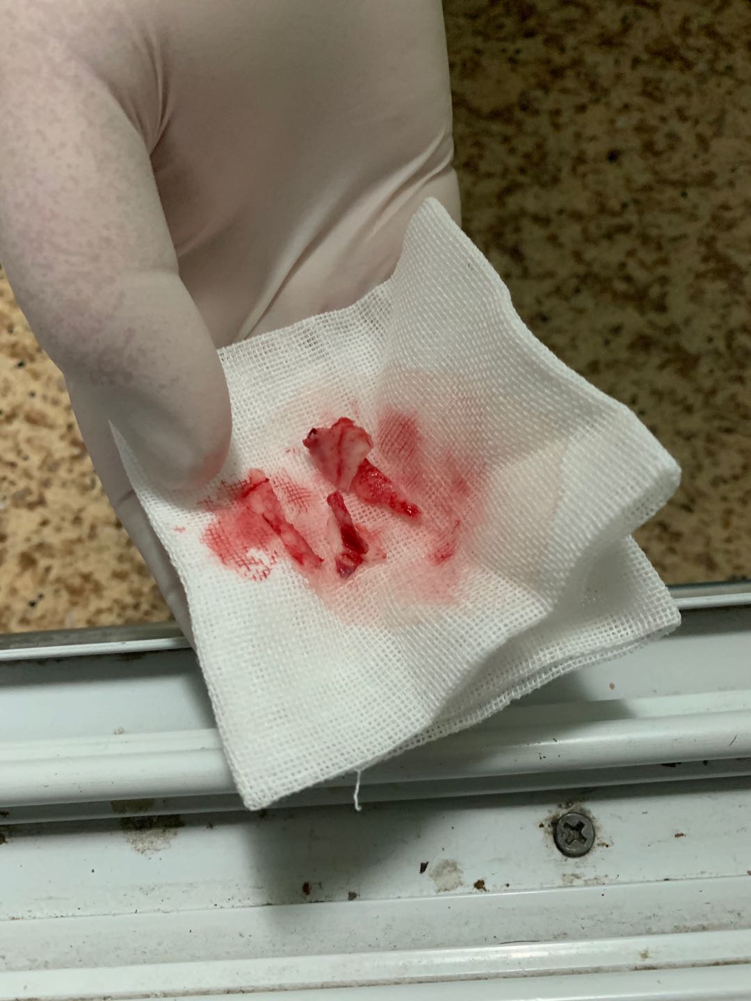 手术取出的4块鼻骨